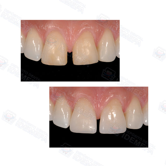 Resina para frente estético ENA HRi/ Micerium