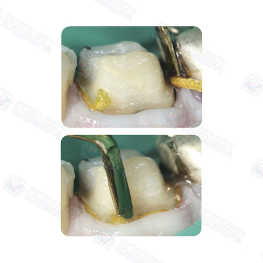 Hilo Retractor Re-Cord™