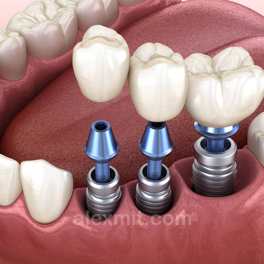 Implantes